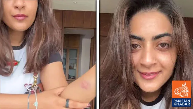 Aamir Khan’s Niece Zeenat Mari Shows Injuries After Detention